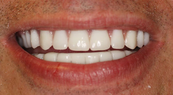 Dental implants after