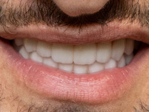 Full mouth reconstruction after