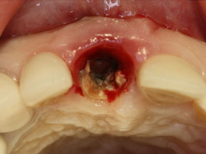 Dental implants before