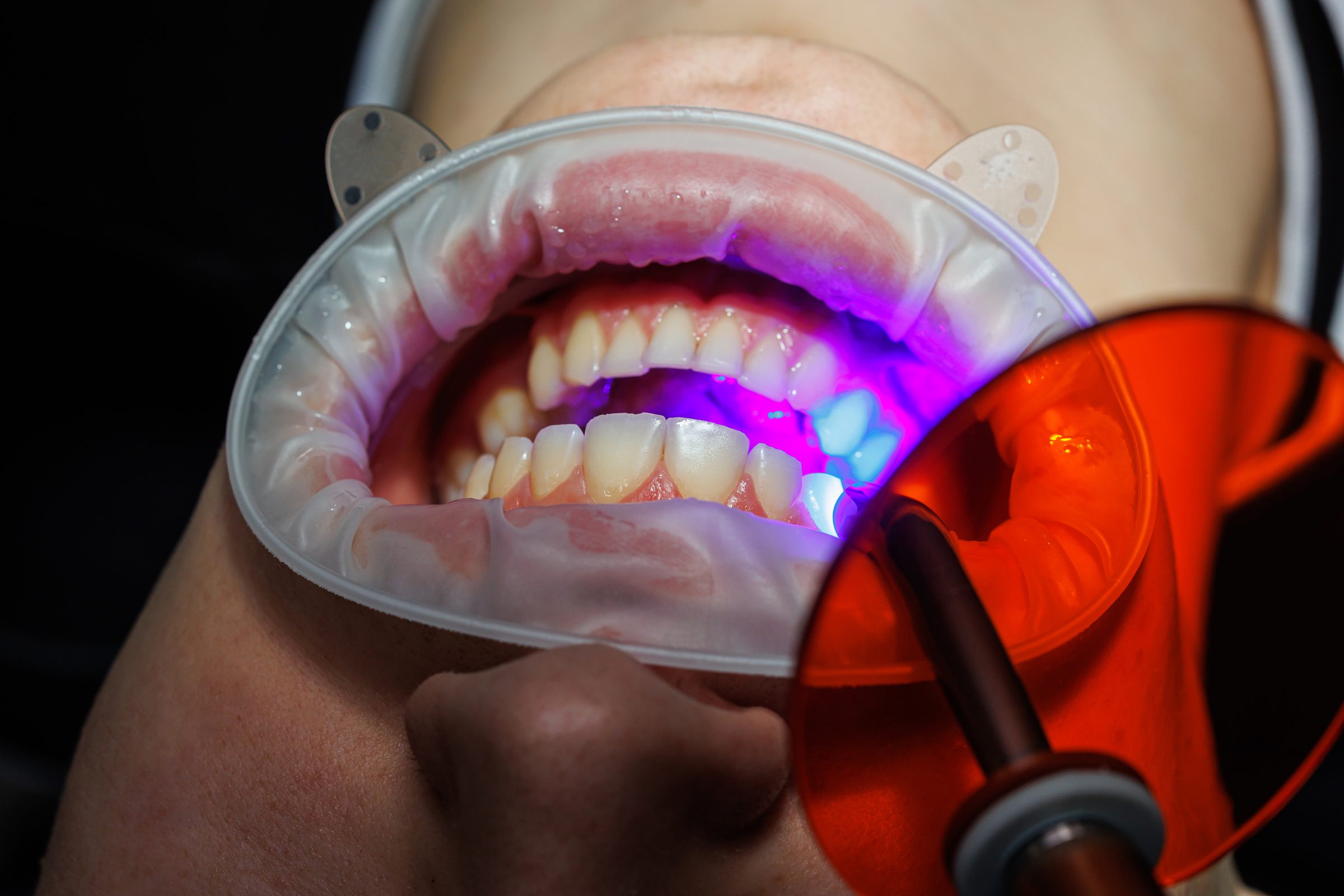Tooth-coloured bonding set with a curing light