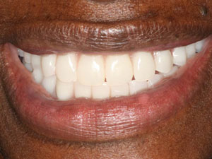 Dental implants after