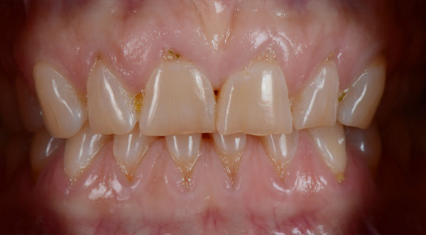 Teeth before porcelain veneers