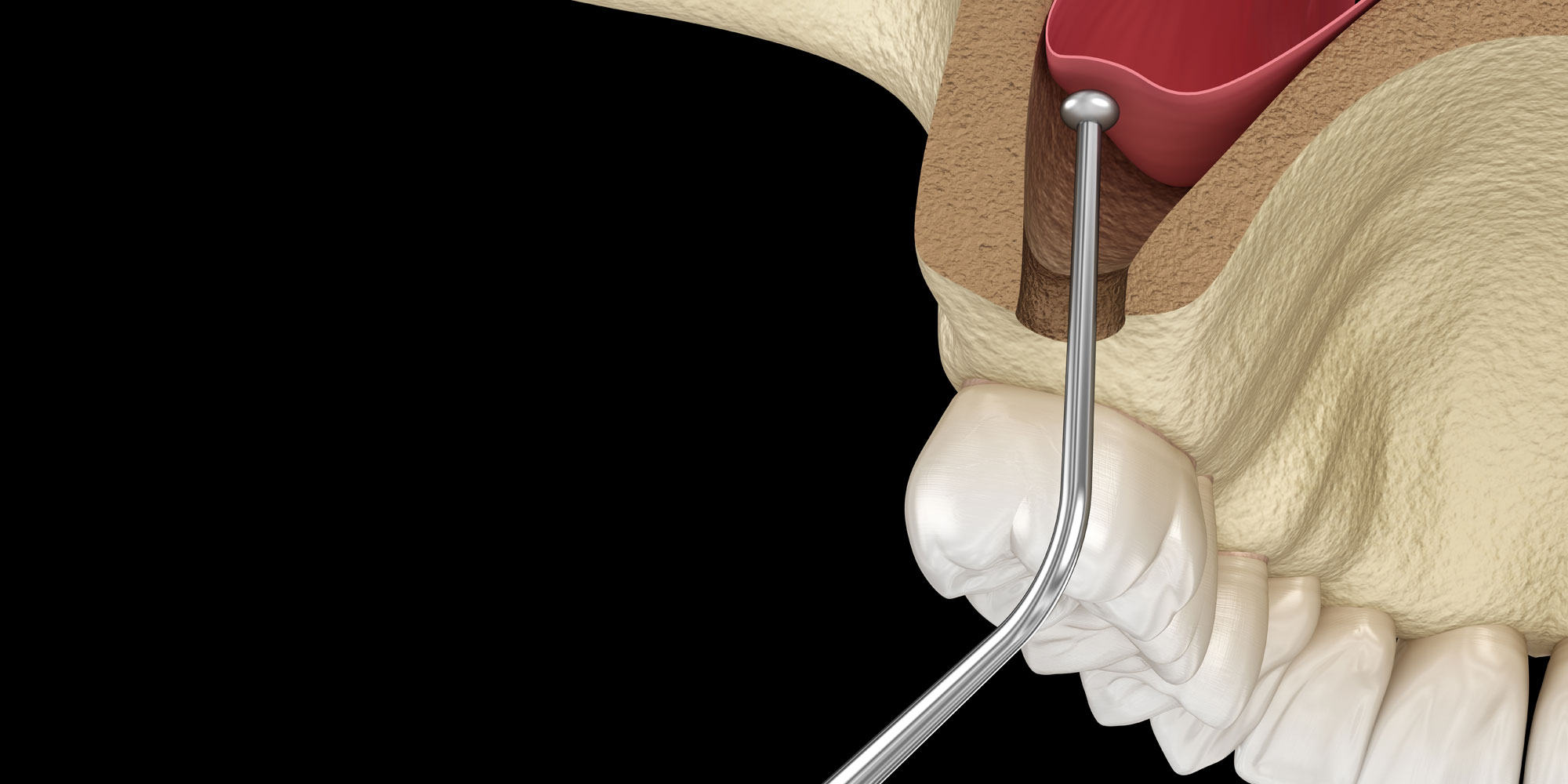 Illustration of a sinus lift adding bone beneath the sinus