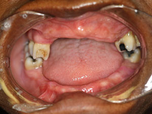 Dental implants before