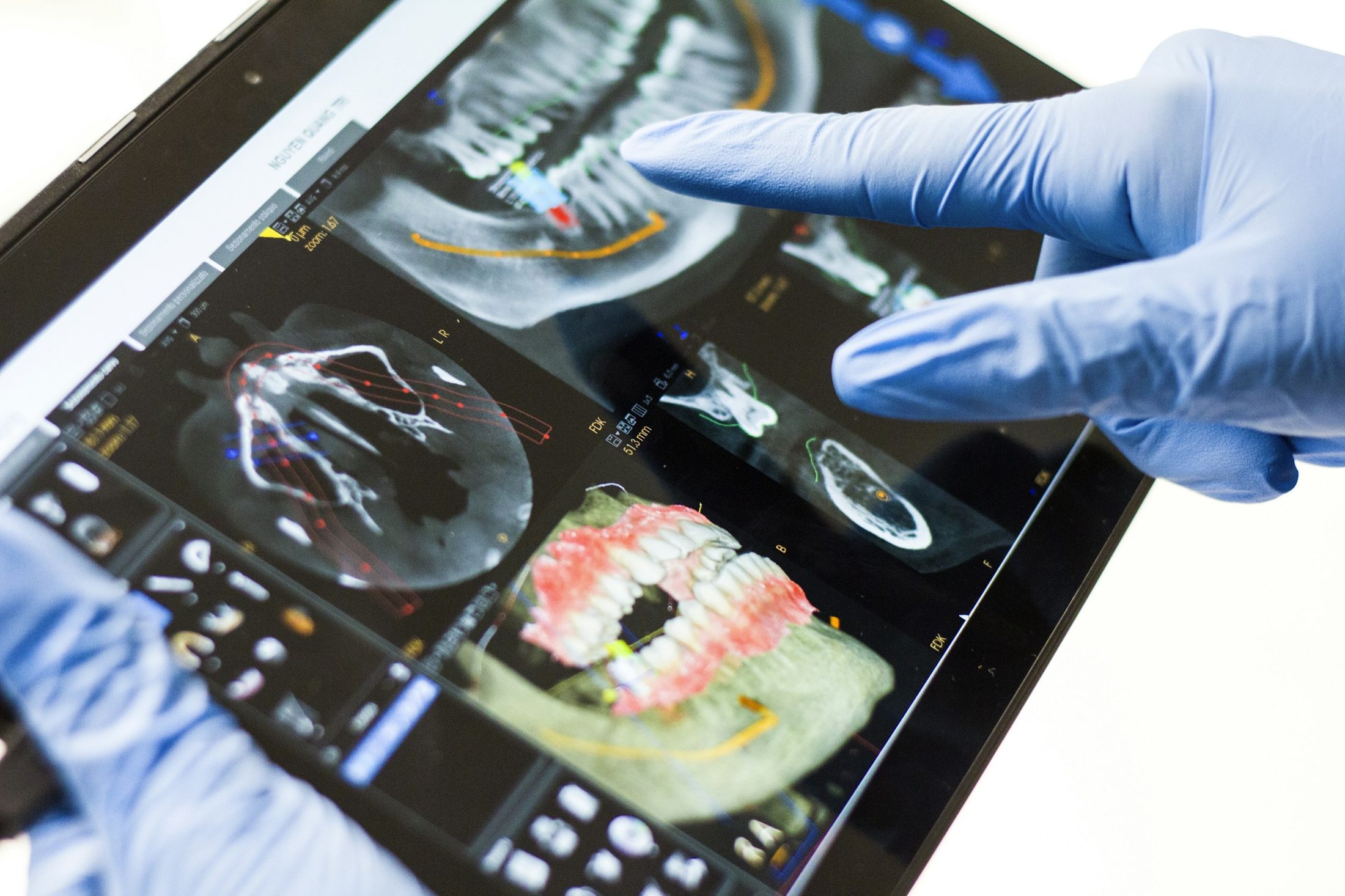 A 3D implant plan on a tablet screen
