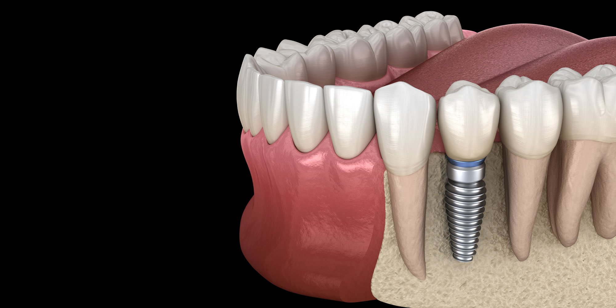 An implant and crown replacing an extracted tooth