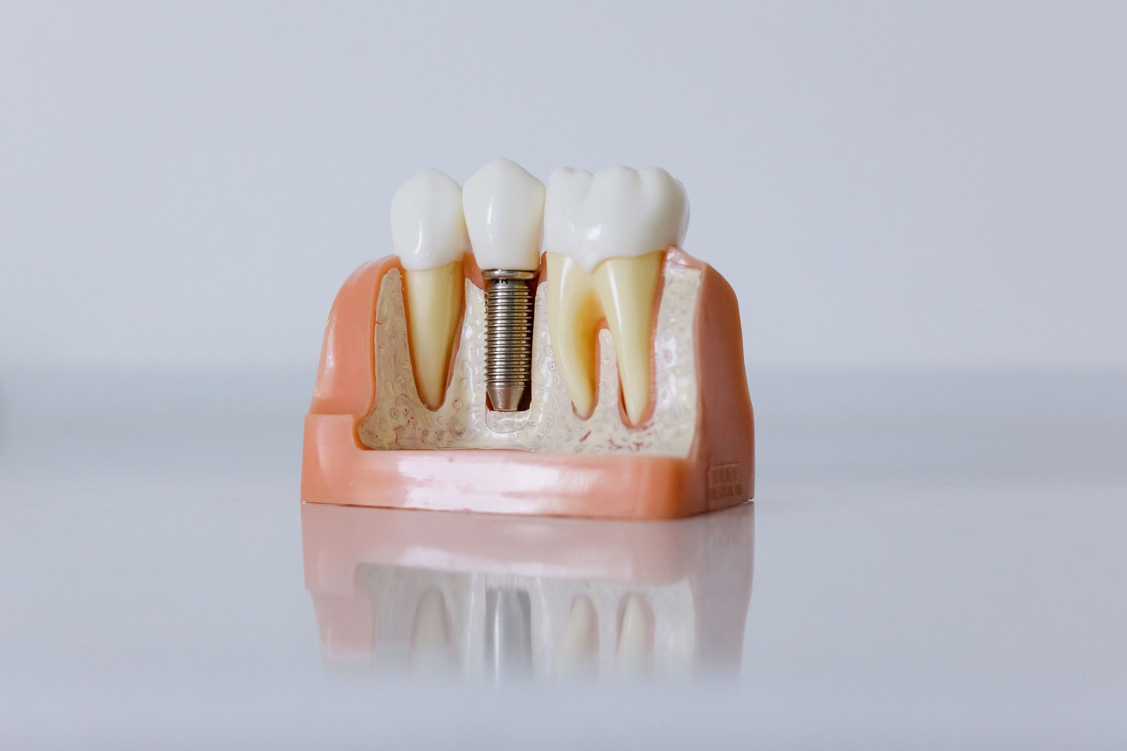 Model of a dental implant set in the jaw bone