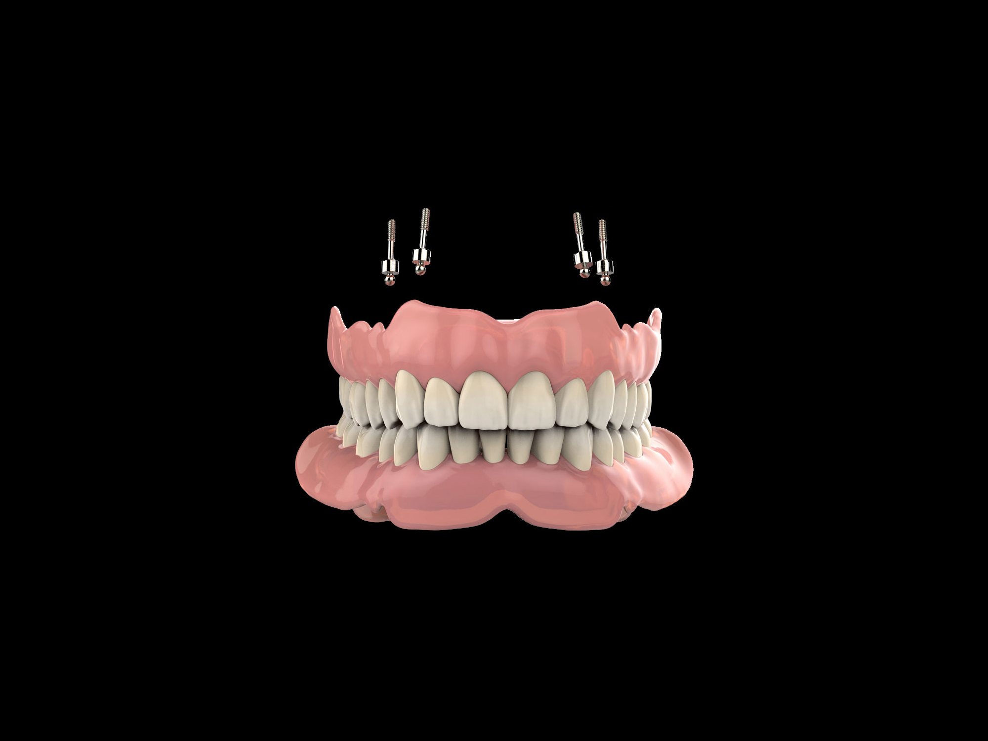 A model of an implant-supported hybrid denture with its four attachment screws