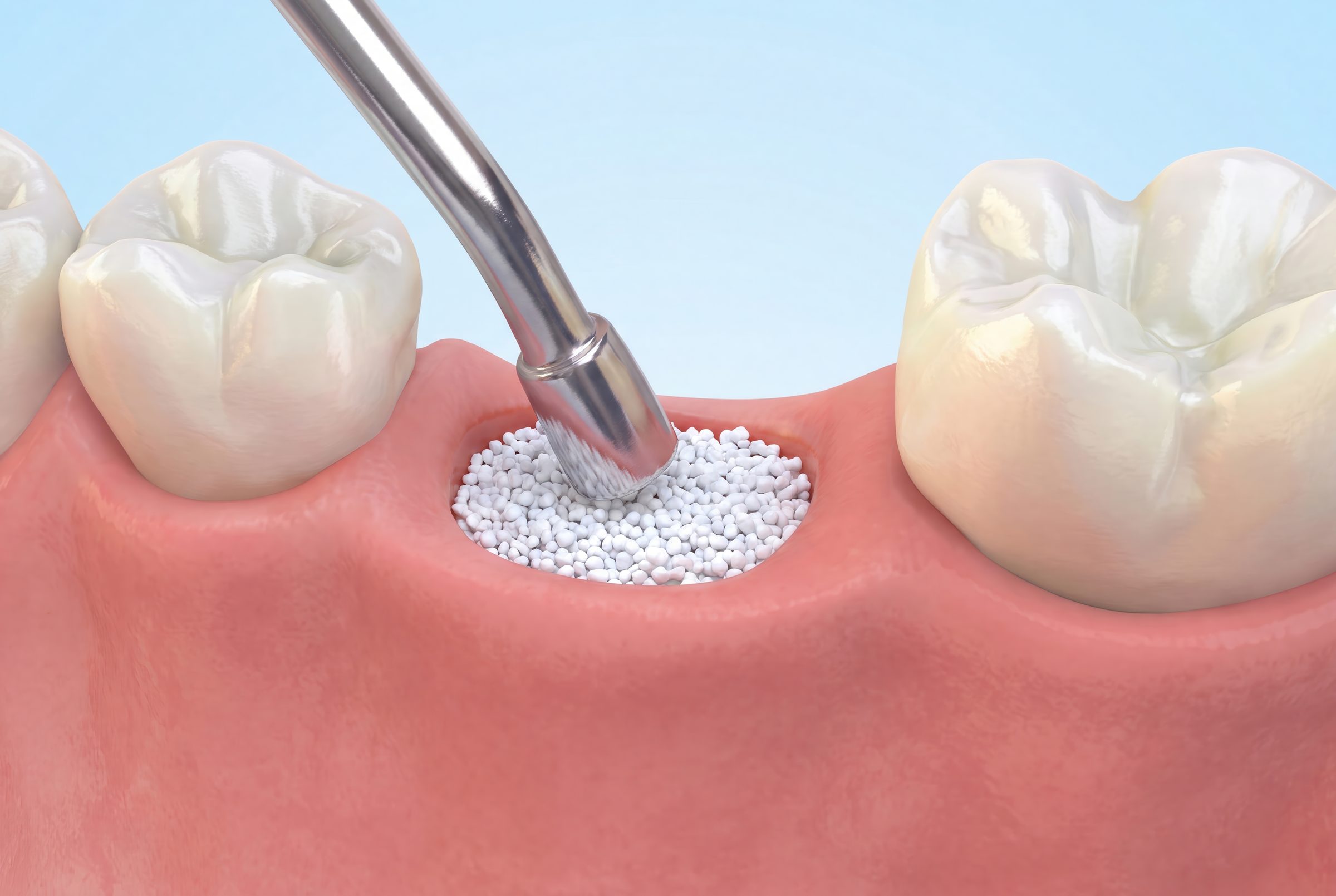 Bone graft granules being packed into a tooth socket