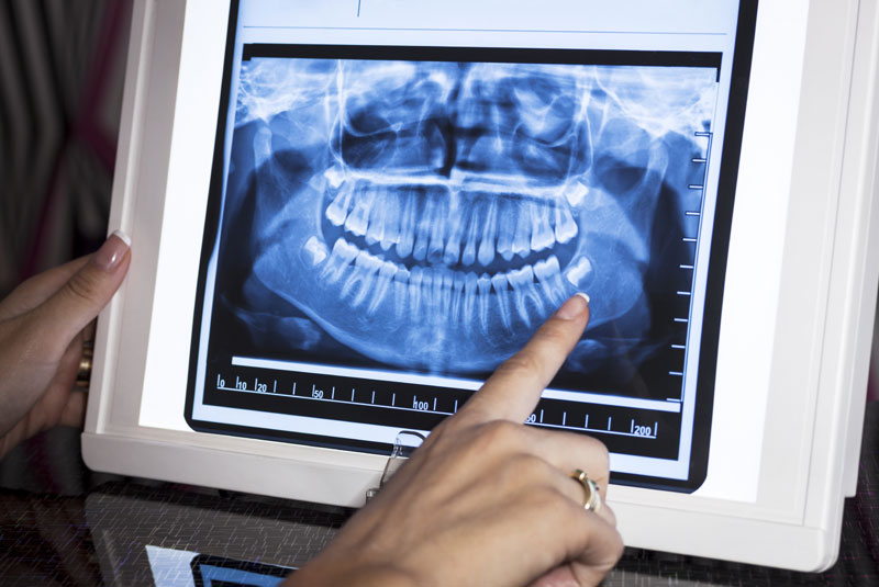 Oral surgeon explaining x-ray to dental implant patient