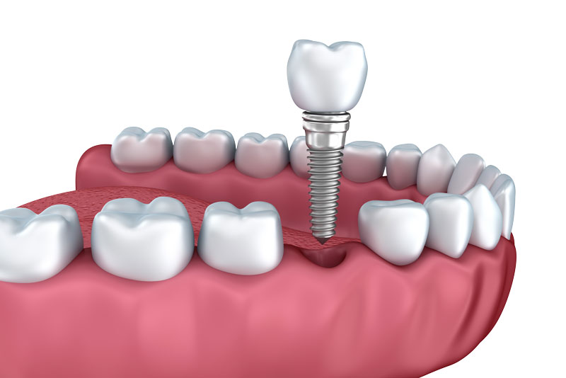 a model of a single dental implant with a titanium post